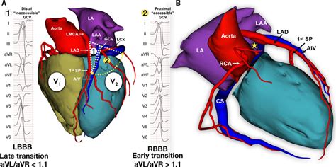 lv summit pvc|right ventricular outflow tract pvcs.